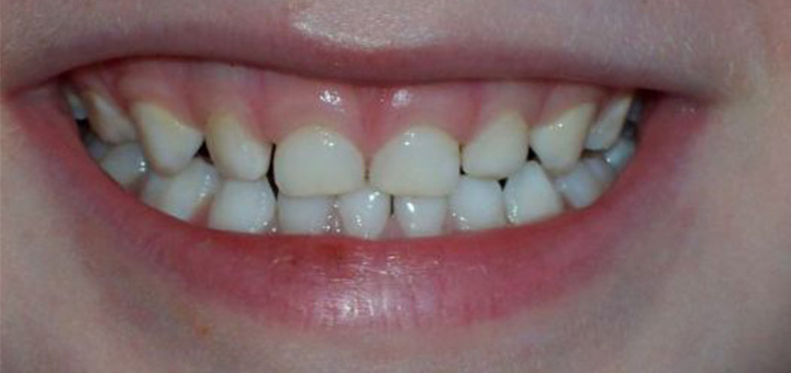 omeopatia-salute-bambini-carie-4-anni-ministero-salute